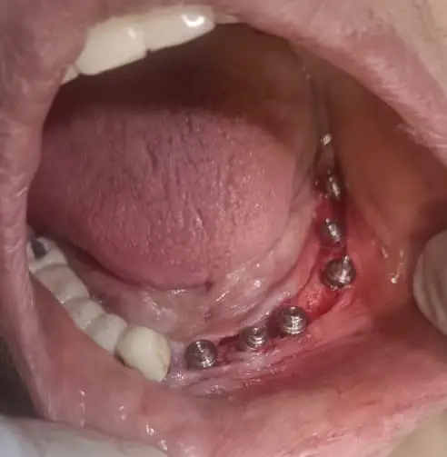 Dental implant consultation at Hyderabad Dental